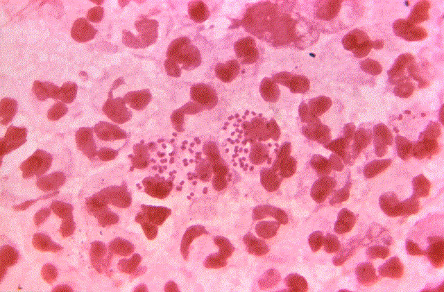 Neisseria gonorrhoeae. CDC/Bill Schwartz